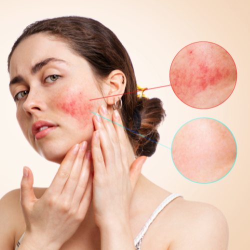Skincare Routine for Redness & Sensitivity - Understanding Redness & Sensitivity