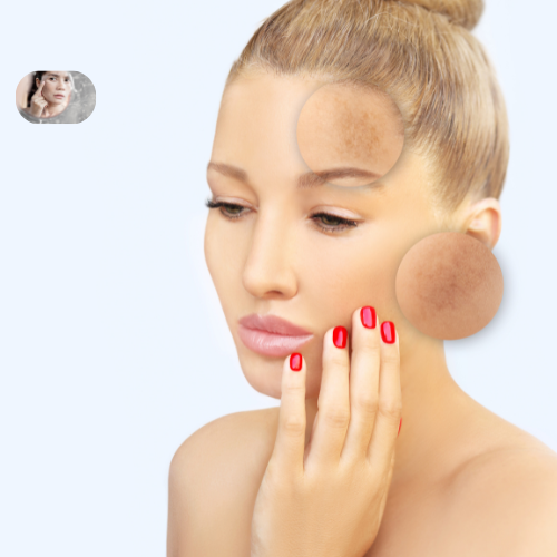 Skincare Routine for Hyperpigmentation - Understanding Hyperpigmentation