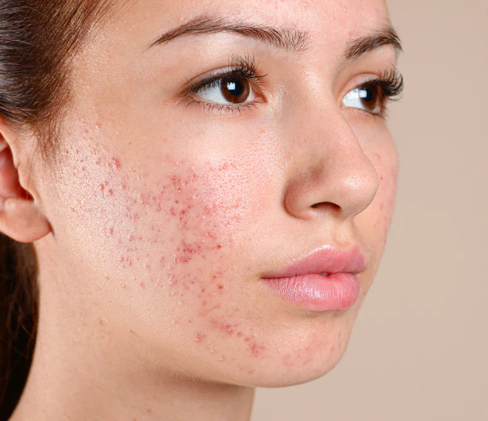 Skincare Routine for Acne & Blemishes - Understanding Acne & Blemishes