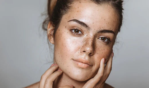 What are the causes of dark spots and how to reduce them?