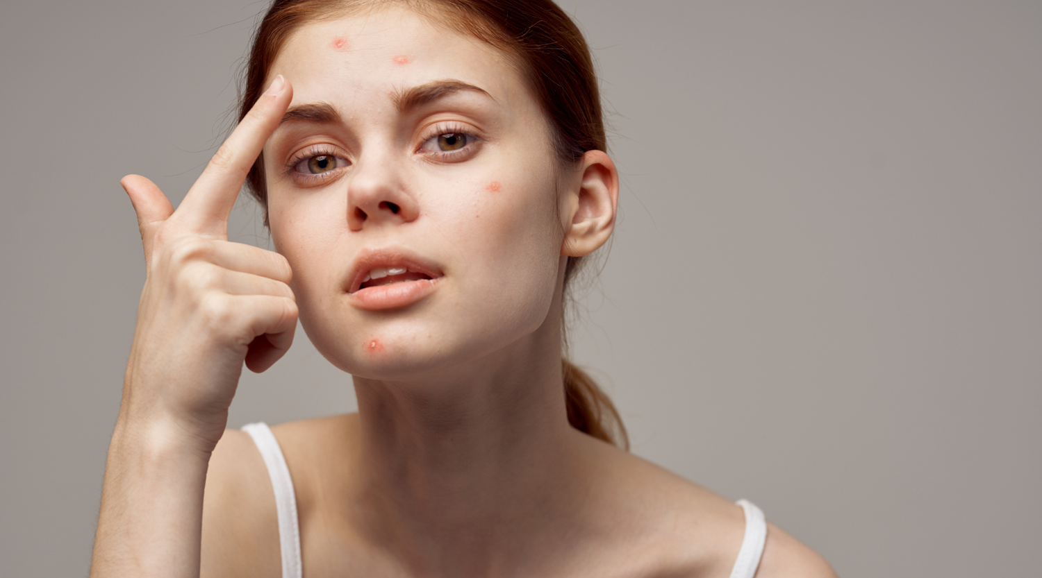 Acne-Prone Skin